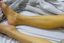 اعراض التهاب الكبد