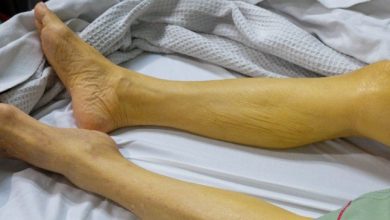 اعراض التهاب الكبد