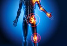 مرض الروماتيزم