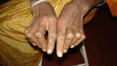 التهاب المفاصل الروماتويدي