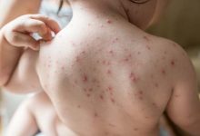 مرض الجدري المائي