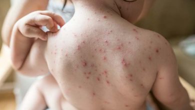 مرض الجدري المائي