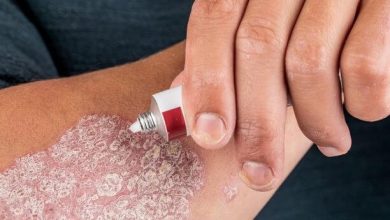 علاج الصدفية