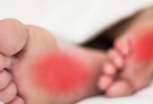 علاج حرارة القدمين الدكتور عبد الباسط