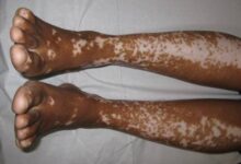 الفرق بين البهاق والفطريات بالصور