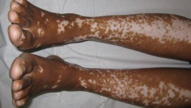 الفرق بين البهاق والفطريات بالصور