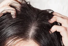 تقشير فروة الراس تجربتي