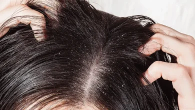 تقشير فروة الراس تجربتي