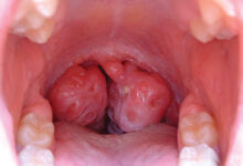 تكلفة عملية اللوز للاطفال في مصر