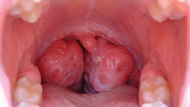 تكلفة عملية اللوز للاطفال في مصر