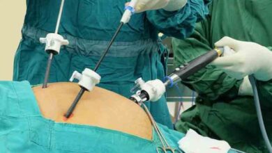 تكلفة عملية المرارة بالمنظار