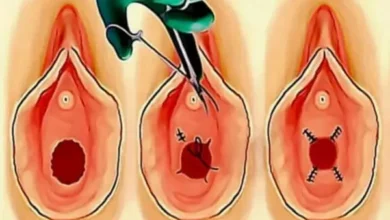 متى تذوب خيوط عملية ترقيع البكارة الدائمة