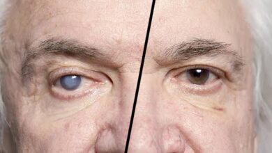 متى يستقر النظر بعد عملية المياه البيضاء