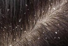 وصفات للتخلص من القشره نهائيا في اقل من ربع ساعه