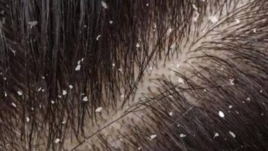 وصفات للتخلص من القشره نهائيا في اقل من ربع ساعه