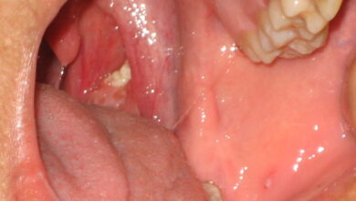 تجربتي مع حصوات اللوز