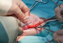 كيف اعرف ان عمليه الفتاق نجحت