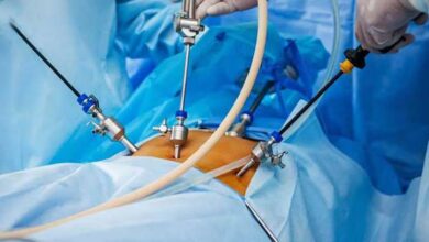 كيف انام بعد عملية التكميم