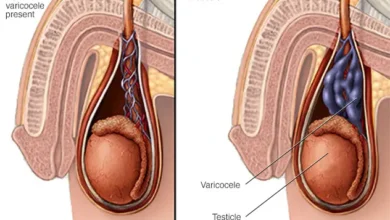 هل دوالي الخصية تسبب العقم