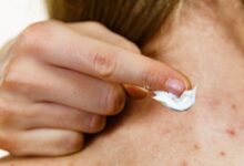 افضل مرهم لازالة اثار الحبوب والبقع الغامقة