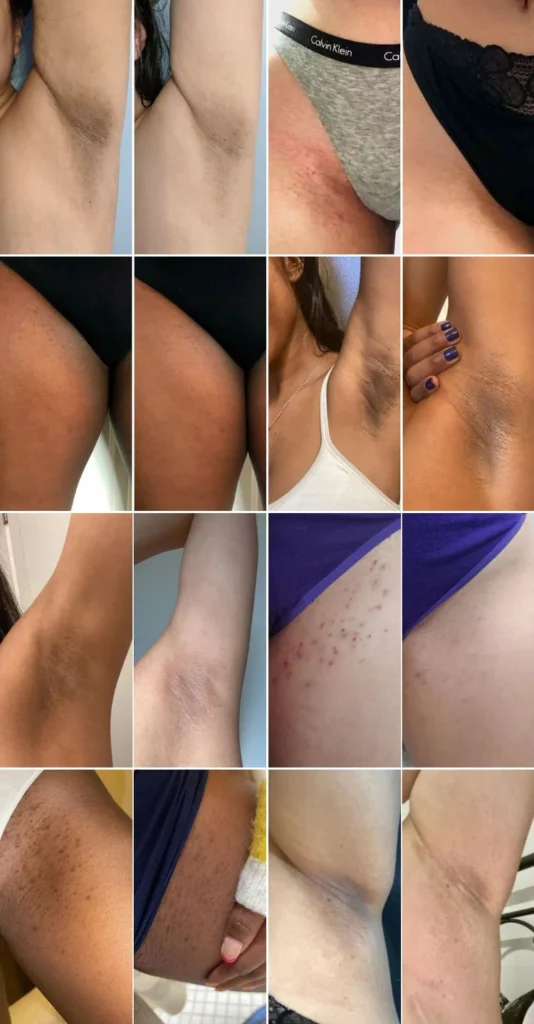 افضل مقشر كيميائي للمناطق الحساسة