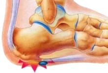 تجربتي مع الشوكة العظمية