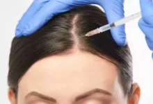 تجربتي مع حقن البلازما للشعر