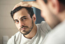 متى تثبت البصيلات بعد زراعة الشعر