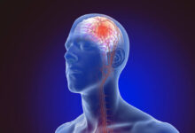 متى يموت مريض الجلطة الدماغية