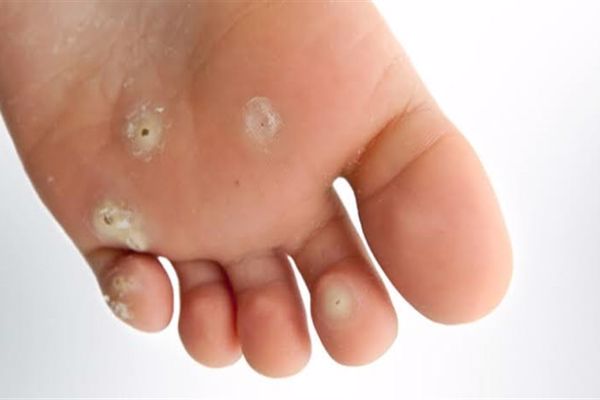 أعراض الإصابة بعين السمكة