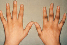 الحل النهائي لسواد مفاصل اليدين