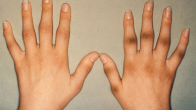 الحل النهائي لسواد مفاصل اليدين