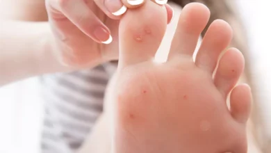 علاج عين السمكة بالليمون