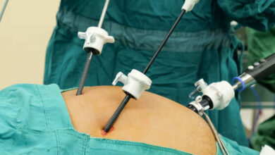 تكلفة عملية المرارة بالمنظار