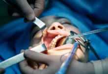 متى تبدا الاسنان تتحرك بعد التقويم