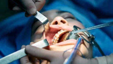 متى تبدا الاسنان تتحرك بعد التقويم