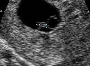 هل وجود دم حول كيس الجنين خطر