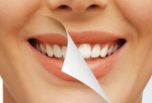 حشوات تجميلية للاسنان الامامية