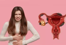 هل يحدث حمل مع وجود كيس دموي على المبيض