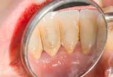 افضل غسول للفم لازالة الجير