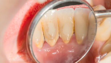 افضل غسول للفم لازالة الجير