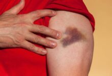 هيموكلار لعلاج الكدمات والتورم